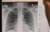 Els casos de tuberculosis descendeixen un 13% en els últims quatre anys en la CV