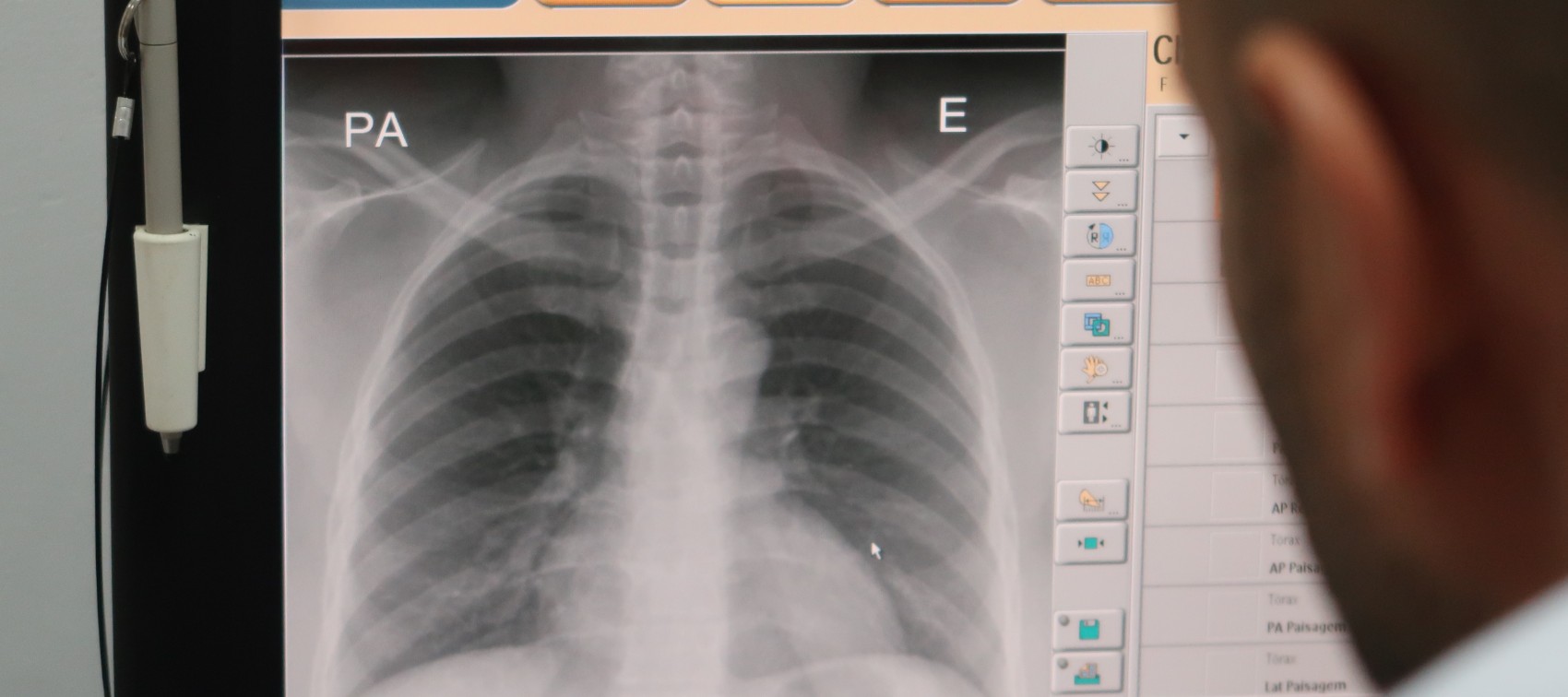 Els casos de tuberculosis descendeixen un 13% en els últims quatre anys en la CV
